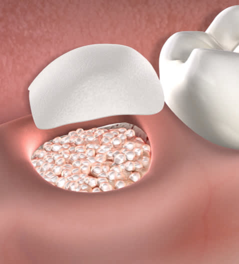 Illustration of bone graft