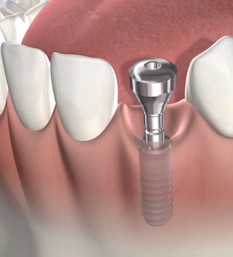 Illustration of a dental implant post | Mount Pleasant, SC