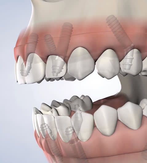 Illustration of full-arch restoration