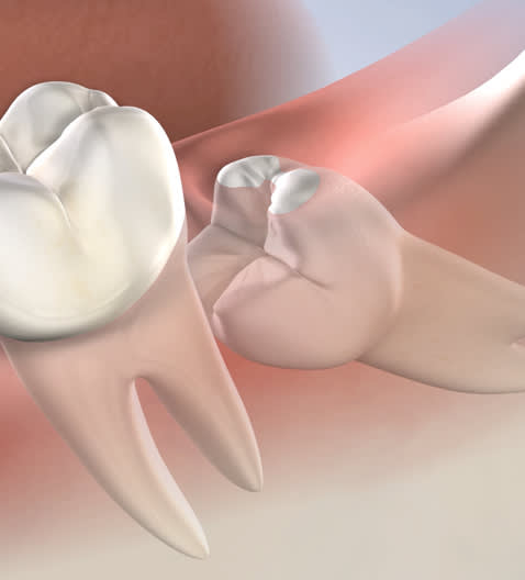 Illustration of impacted wisdom teeth