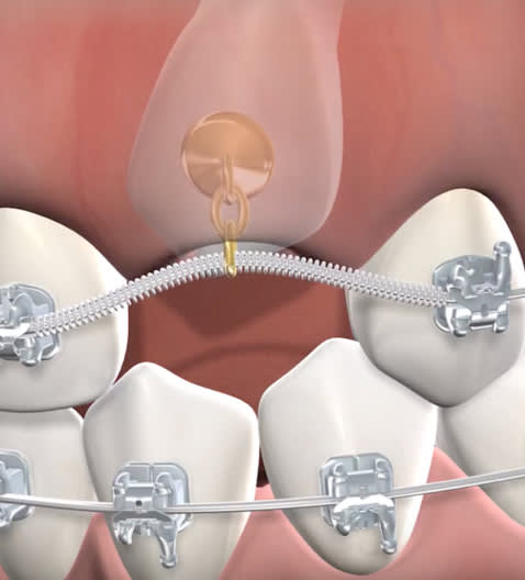 Illustration of impacted canines